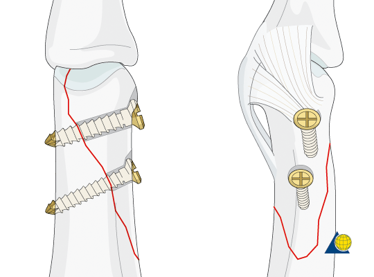 Straining Forward: Anatomy and Physiology: Treatments for Broken Bones
