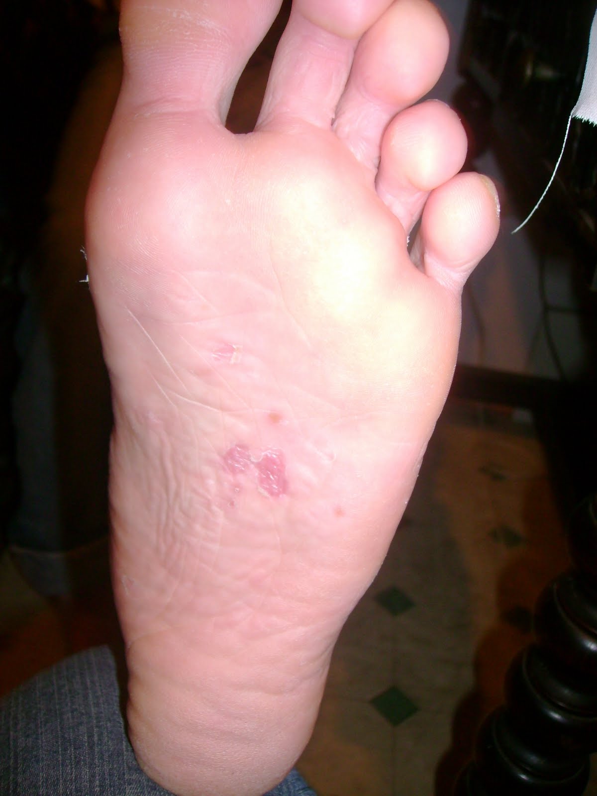 EHLERS DANLOS &quot;ENLACES&quot; Argentina HIDROSIS E