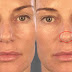 Bulbous nose Pictures, Definition, rhinoplasty, Contouring, Reduction