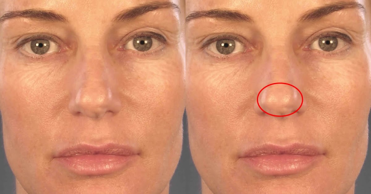 Bulbous nose Pictures, Definition, rhinoplasty, Contouring, Reduction