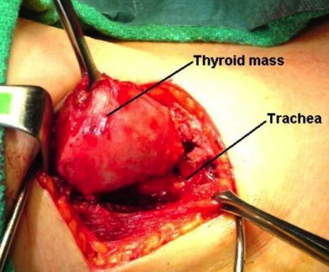 Thyroid tumors in dogs