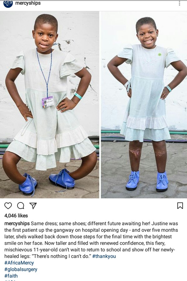 Photo: 11-year-old Girl With Extreme Bow Legs Undergoes Surgery And The Result Is Amazing!
