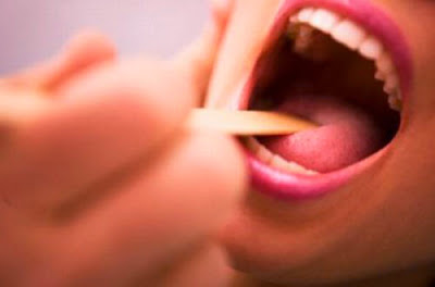 Triệu chứng và nguyên nhân bệnh ung thư amidan Triệu chứng và nguyên nhân bệnh ung thư amidan