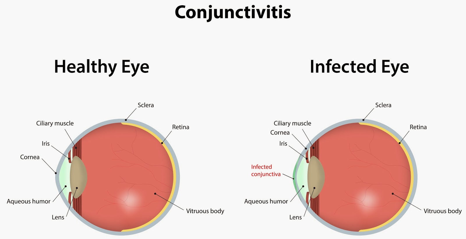 Vision pro optical what is pink eye the story of conjunctivitis