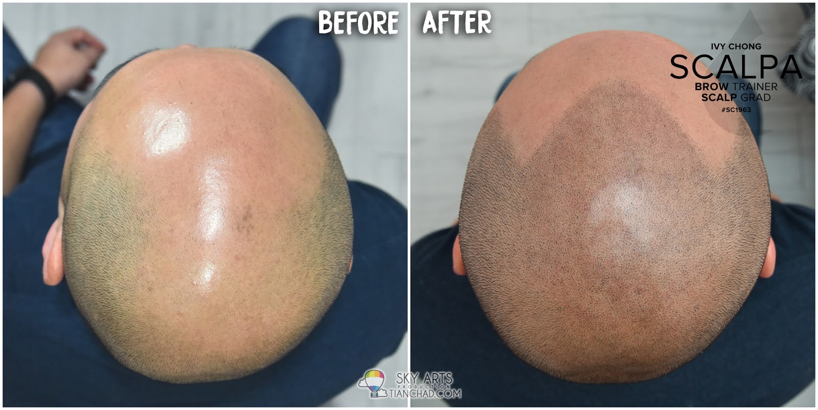 Best Scalp Micropigmentation (SMP) in Malaysia SMP 让你不再为秃头而烦恼