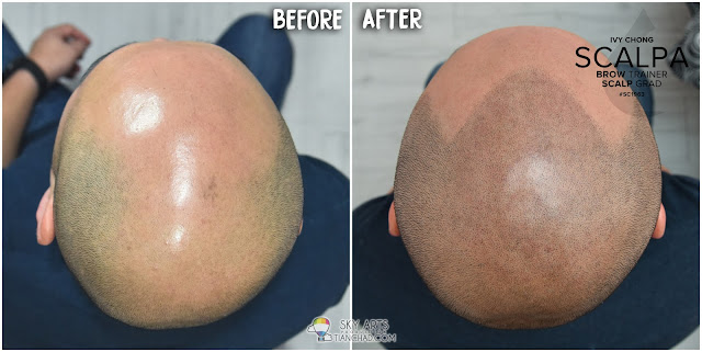 BEFORE and AFTER look of the scalp after TWO session of Scalp Micropigmentation (SMP) treatment 