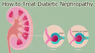 How to Treat Diabetic Nephropathy