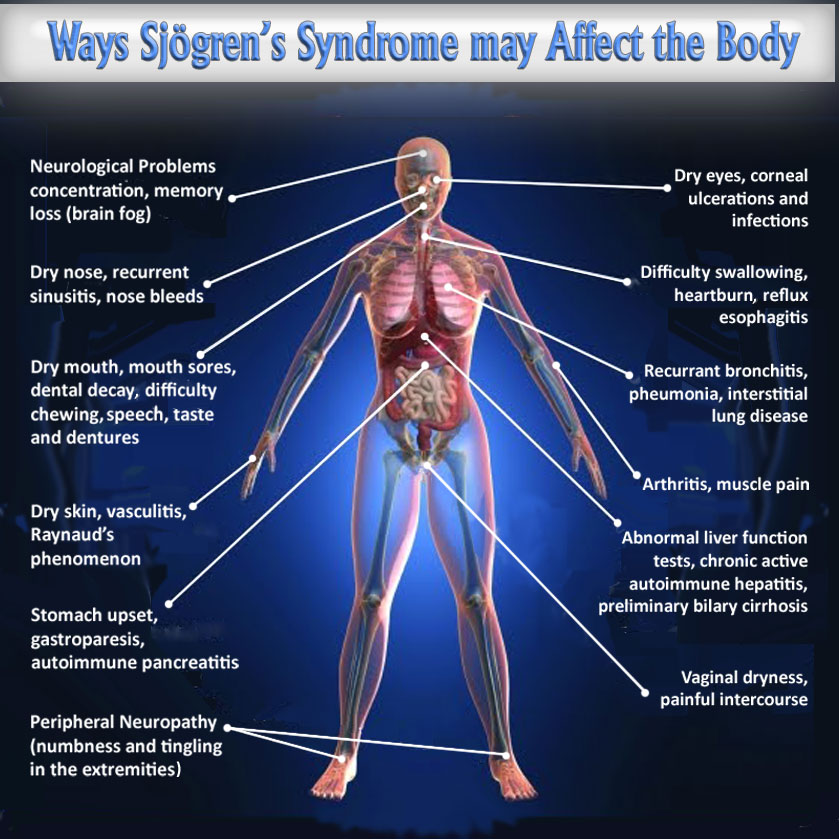 Many Symptoms Of Sjogrens Syndrome Are Neuropathic Neuropathy And Hiv