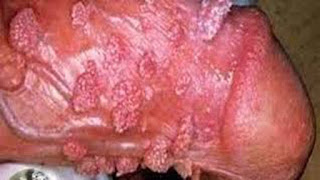 Paket Obat Kutil Kelamin De Nature