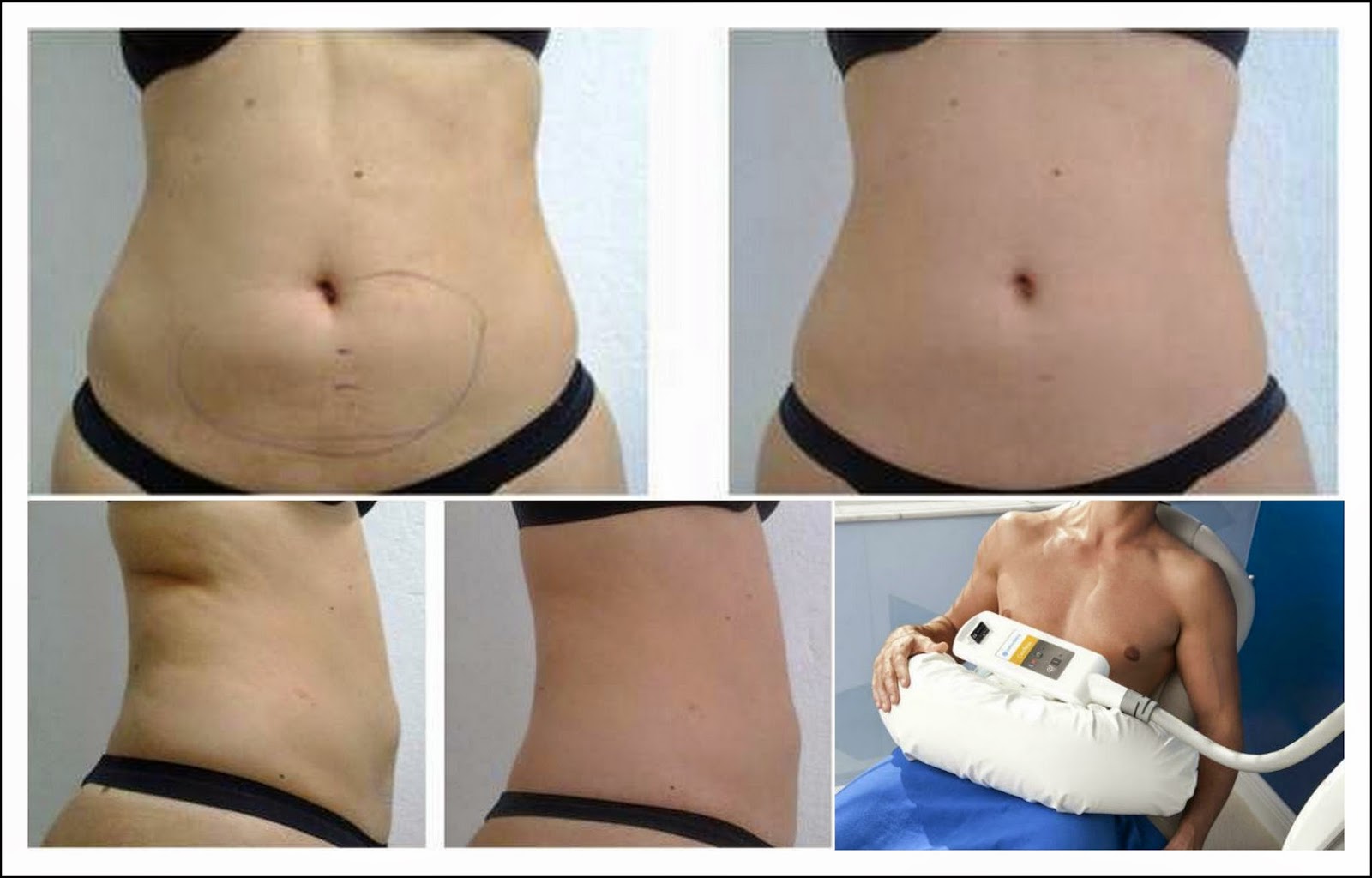 NOTICIAS DA HORA: NOVA LIPO SEM CORTES COM RESULTADOS NA HORA!