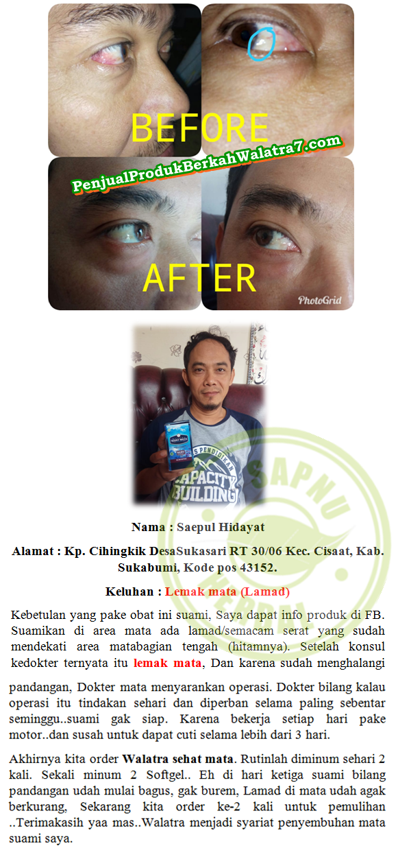 Cara Mengobati Mata Uveitis Secara Alami Dan Cepat ~ TESTIMONI WALATRA SEHAT MATA SOFTGEL Cara Mengobati Mata Uveitis Secara Alami Dan Cepat ~ TESTIMONI WALATRA SEHAT MATA SOFTGEL