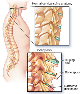 What Is Spondylosis? - Spondylosis Treatments, Causes & Symptoms