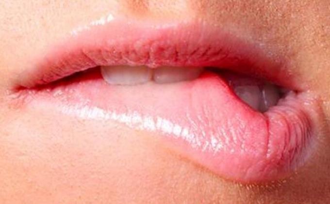 Penyebab Sariawan Pada Mulut Artikel Bermanfaat