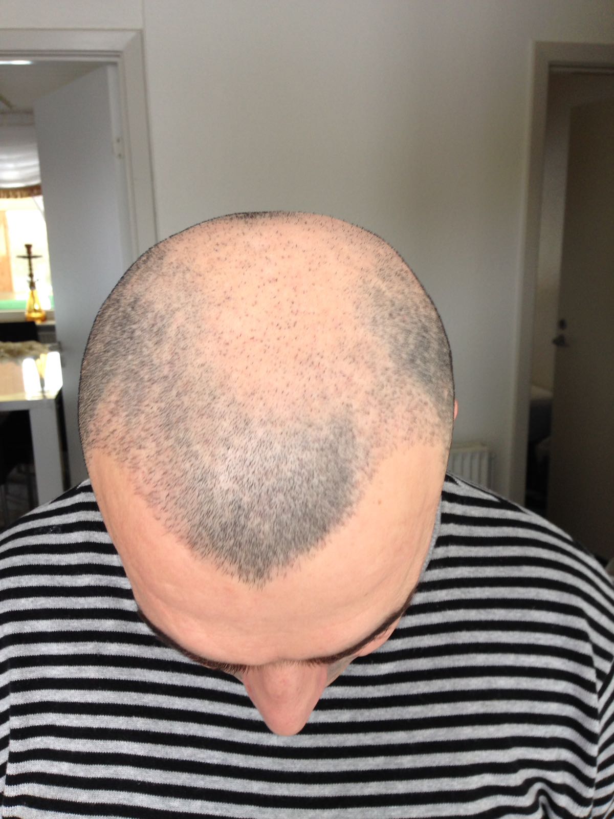 زراعة الشعر - تجربتي الشخصية - YouTube
