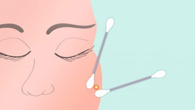Cách nặn mụn an toàn tại nhà