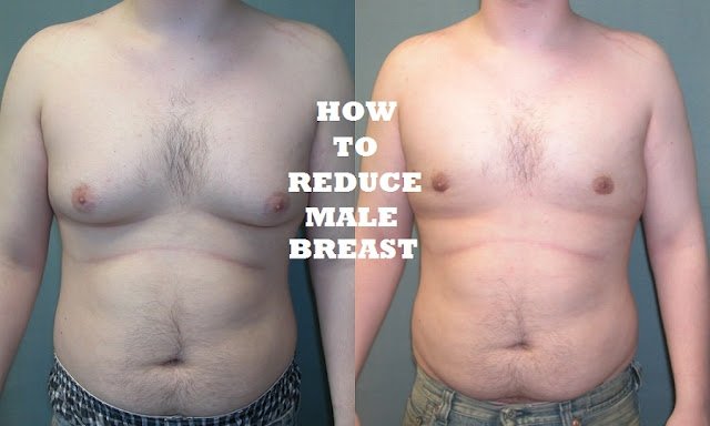 Enlarged Male Breast 80