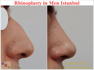 Nose Job Surgery for Men - Male Rhinoplasty - Men's Rhinoplasty - Nose Reshaping for Men - Mens Rhinoplasty - Nose Job Rhinoplasty for Men - Best Rhinoplasty For Men Istanbul - Nose Aesthetic for Men - Male Nose Operation - Male Rhinoplasty Surgery in Istanbul - Male Rhinoplasty Surgery in Turkey - Male Nose Aesthetic Surgery - Rhinoplasty In Mens
