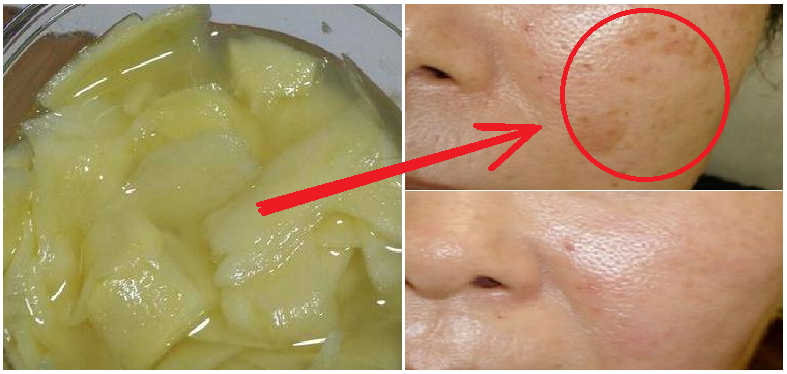 Manfaat Cuka Dapur Untuk Wajah Desainrumahid Ajaib Ibu 43 Tahun Ini Mengoleskan Campuran Jahe Dan Madu Di Manfaat Cuka Putih Beli Dimana Untuk Wajah