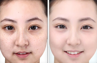 Cách xông hơi da mặt trị nám cach-xong-hoi-da-mat-tri-nam