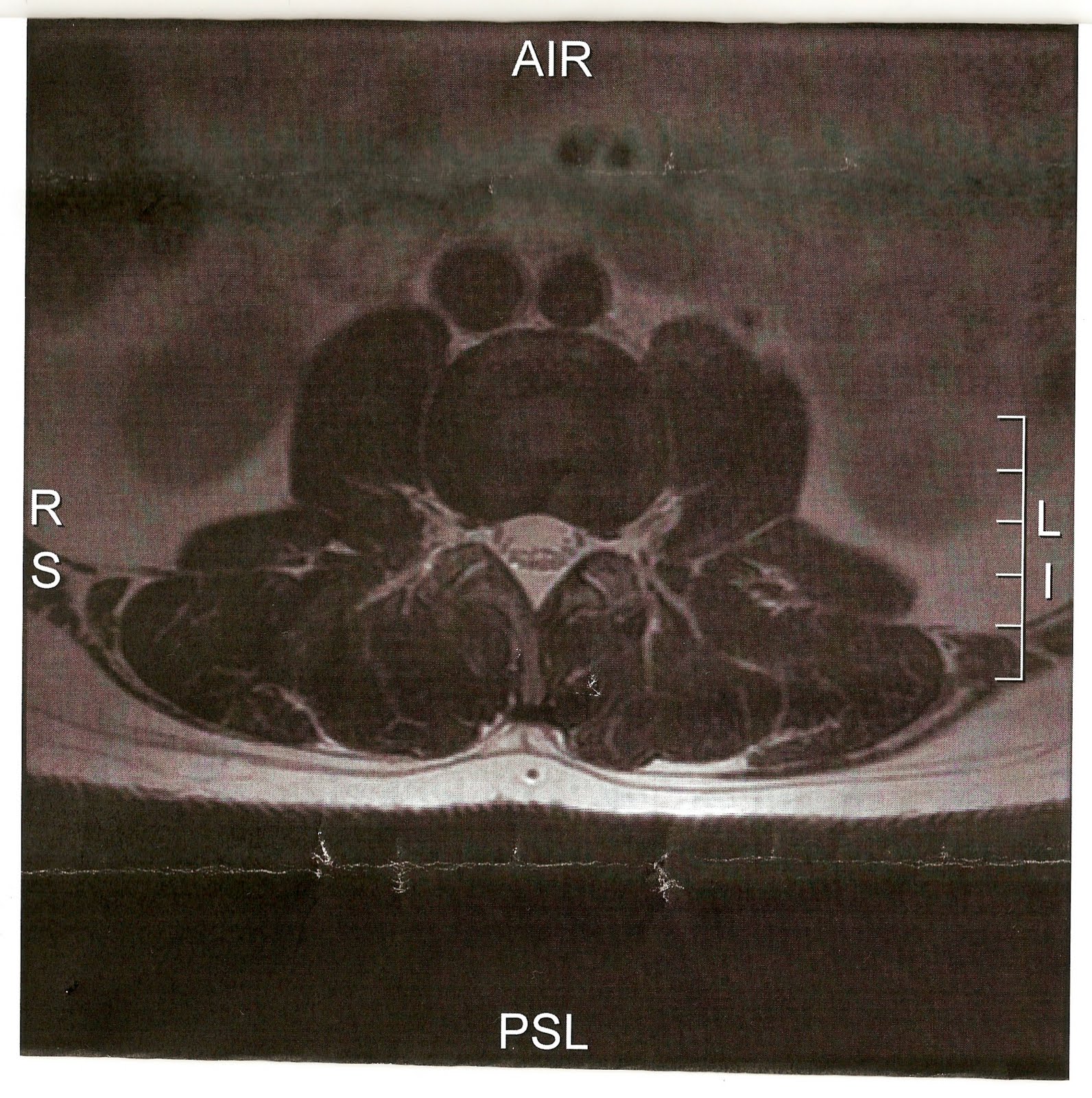 Schmorl'S Node Surgery: Realistic Recovery Time & Pain Management - ugp5sas