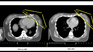 Image comparison of the heart with Active Breathing Control (ABC), and without ABC