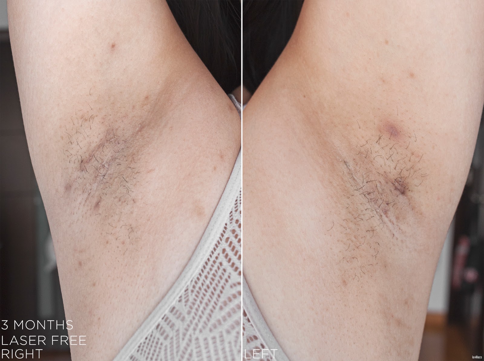 tria Hair Removal Laser Armpits Hair 3 Months Laser Free
