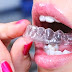 Khách hàng khám phá các bước niềng răng clear aligner là như thế nào?