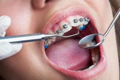  Nguyên nhân gây niềng răng bị sưng lợi 