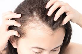 زراعة الشعر للنساء زراعة الشعر للنساء