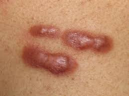 Pengobatan Tradisional Penyakit Keloid