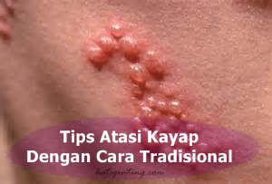 Tips Atasi Kayap Dengan Cara Tradisional | kateginting.com http://www.kateginting.com/2017/09/tips-atasi-kayap-dengan-cara-tradisional.html