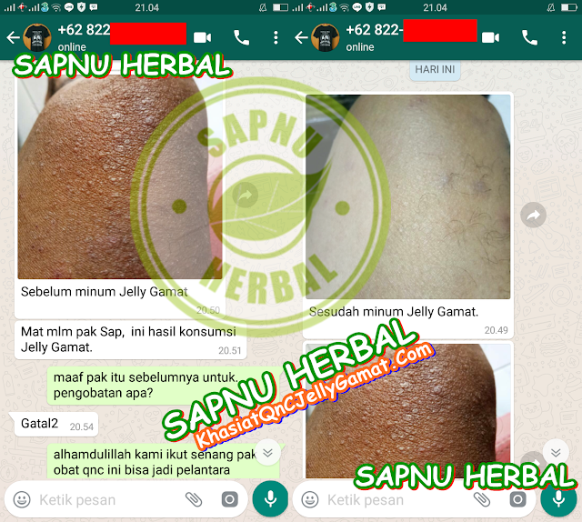 Cara Mengobati Kurap Di Selangkangan Secara Alami Sampai Tuntas Cara Mengobati Kurap Di Selangkangan Secara Alami Sampai Tuntas