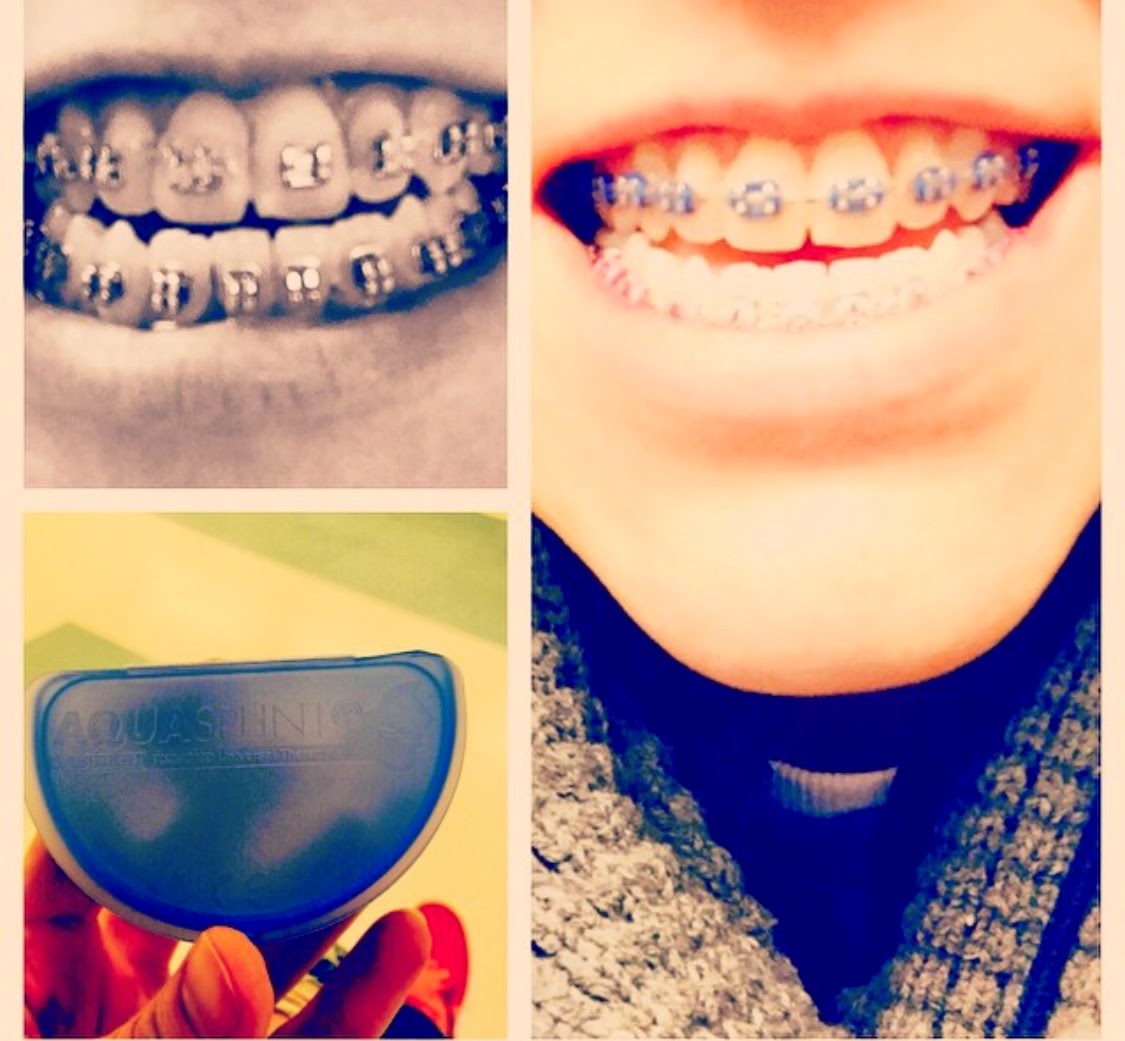 Braces, Jaws, and Joints. Temporomandibular Joint Disorder (TMJ, TMD