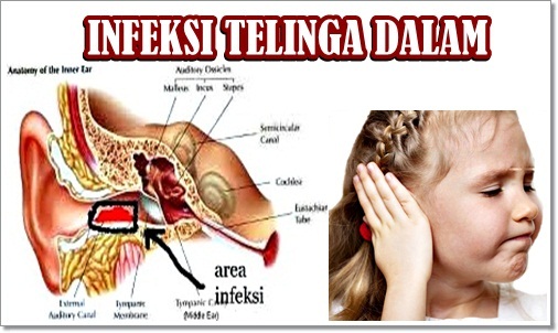 Ubat Sakit Telinga