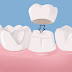 Những trường hợp nào nên làm răng sứ ?