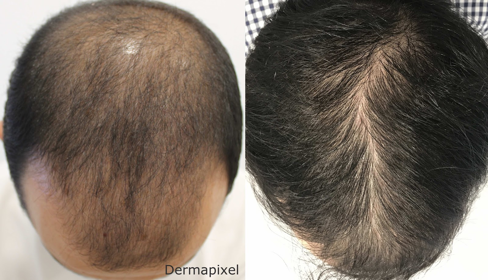 Alopecia androgénica: El trasplante de pelo es todo