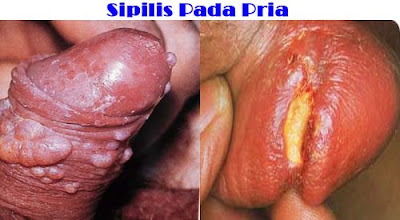  Penyakit Obat Sipilis
