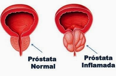 Prostatitis és aloe