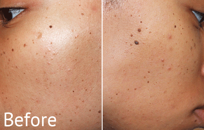 Fresh Lengths Skincare Dermatosis Papulosa Nigra Removal Fresh Lengths Skincare Dermatosis Papulosa Nigra Removal