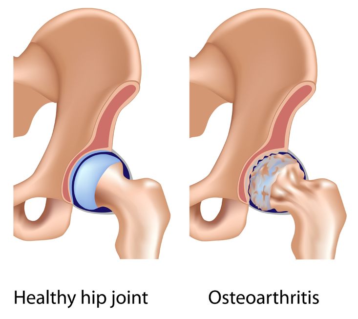Physical Health Hip Joint Pain Relief