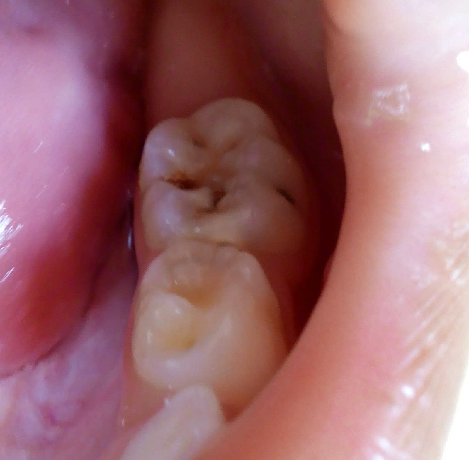 Dental Caries Process and Principles of Dental Caries Cavity