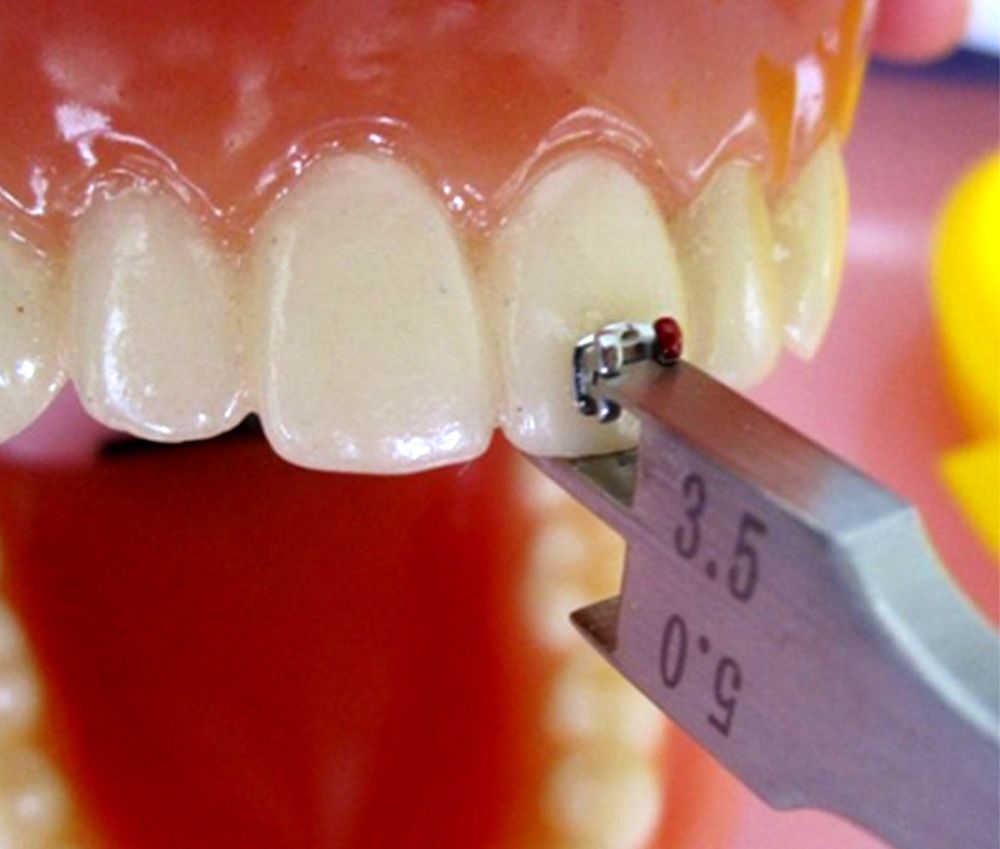 ORTHODONTIC Procedure for Dental Braces Directorio Odontológico