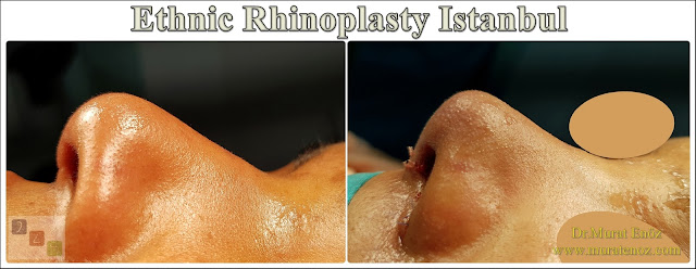 Ethnic Rhinoplasty Istanbul – Dr.Murat Enoz – Nose job in Istanbul – Nose surgery in Istanbul – Nose job in Turkey - Ethnic rhinoplasty Turkey - Ethnic rhinoplasty in Turkey - African American rhinoplasty - Ethnic expert nose job surgeon - Rhinoplasty surgeon in Istanbul - Black nose job - Rhinoplasty for ethnic nose - Rhinoplasty for African people - African American nose surgery – Rhinoplasty for African American Nose - Thick skin rhinoplasty - Rhinoplasty in istanbul Ethnic Rhinoplasty Istanbul – Dr.Murat Enoz – Nose job in Istanbul – Nose surgery in Istanbul – Nose job in Turkey - Ethnic rhinoplasty Turkey - Ethnic rhinoplasty in Turkey - African American rhinoplasty - Ethnic expert nose job surgeon - Rhinoplasty surgeon in Istanbul - Black nose job - Rhinoplasty for ethnic nose - Rhinoplasty for African people - African American nose surgery – Rhinoplasty for African American Nose - Thick skin rhinoplasty - Rhinoplasty in istanbul