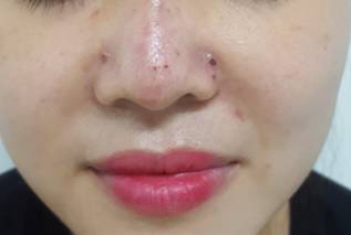 Biến chứng nguy hiểm do tiêm chất làm đầy phải cấp cứu Biến chứng nguy hiểm do tiêm chất làm đầy phải cấp cứu
