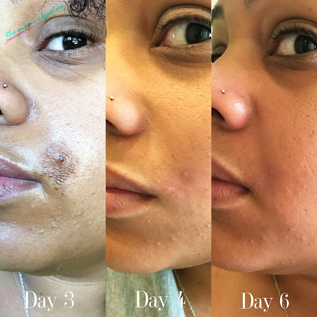 Tamanu Oil and Shea Butter Works, Y'all - How I Healed Burned Naturally Skin in 4 Days