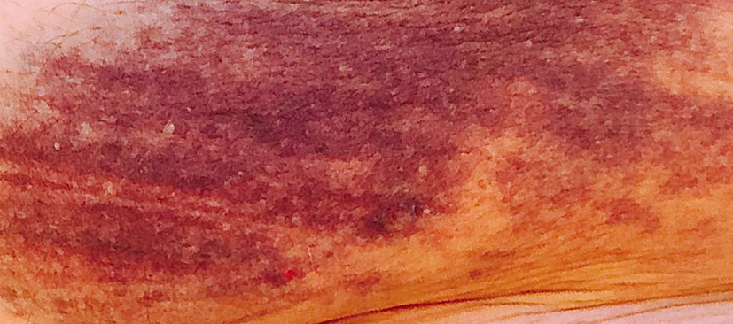 Random pinpoint red dots on skin easy bruising - luckyJuli