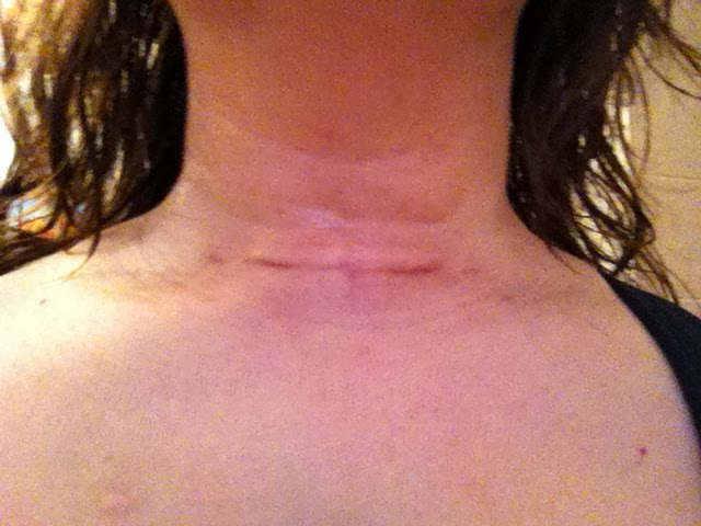 My Thyroidectomy A Personal Account Scar 5 weeks post