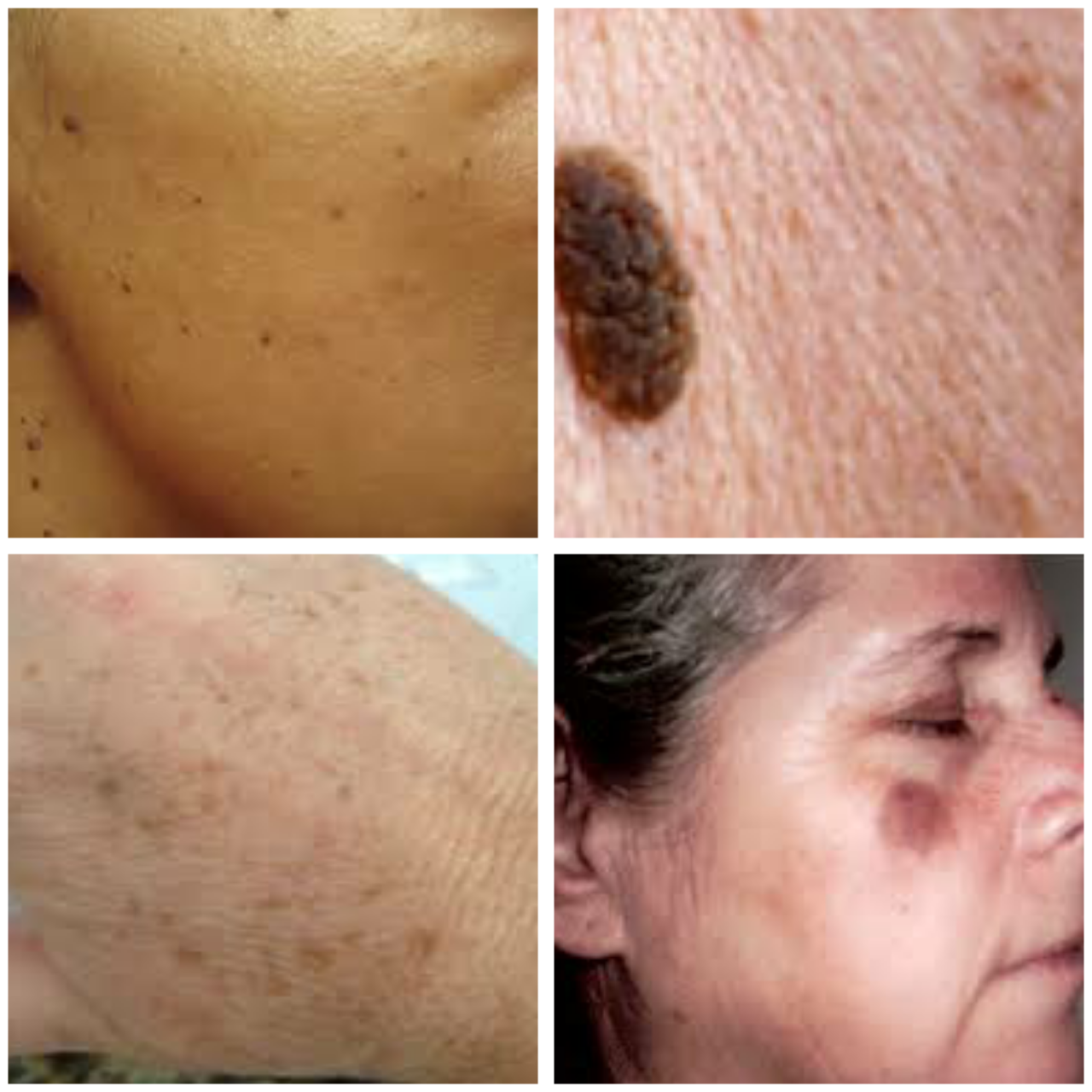 What causes dark spot on the skin