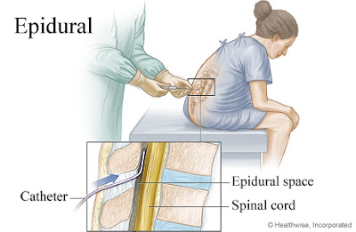Image result for kesan suntikan epidural