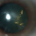 christmas tree cataract